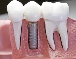 Dental implant Brooklyn To restore or replace missing tooth or missing teeth dental implants or tooth implants can be placed and then  a new ceramic tooth or teeth will be attached to tooth implant to complete a job.
