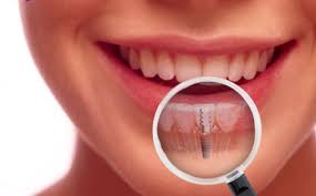 Dental implant Brooklyn New York. How to get functional and healthy teeth if you have missing tooth or missing teeth. Best solution for tooth replacement - dental implants with subsequent teeth crowns.