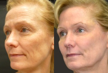 botox new york | facial aesthetics |revitta | wrinkle treatment new york