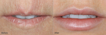 lip injection revitta new york | juvederm lips | restylane lip volume | dermal fillers | juvederm new york | radiesse new york 